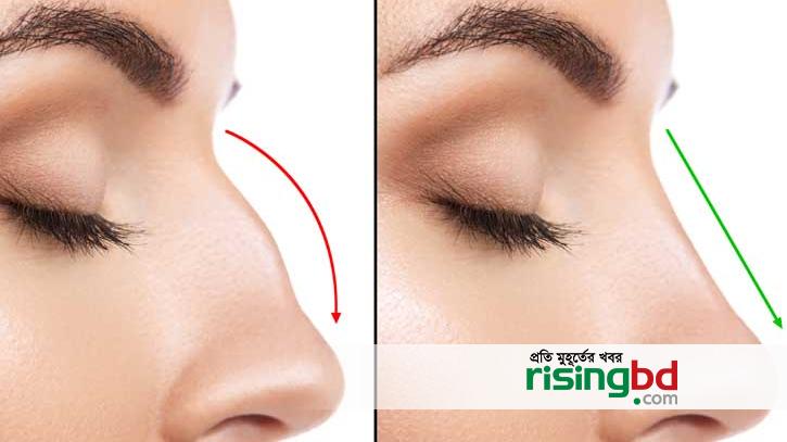 The nose bone is bent, when the operation is needed?