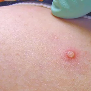 Be aware of empox, prevent outbreaks